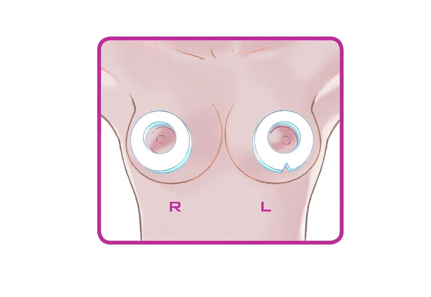 ELANEE Brust-Ringe, Schutz Der Brustwarze Bh-Kontakt Durch Hohllagerung, Ideal Bei Wunden, Entzündeten Brustwarzen Durch Stillen, 10 Stück (222-00) Zubehör Lebensmittel und Stillen Bebe Naty Shop