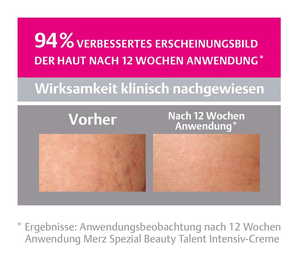 Merz Spezial, Intensivcreme gegen Dehnungsstreifen, 75 ml Kosmetik und Beauty Naty Shop